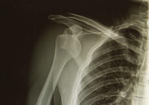 What Is A Closed Reduction Procedure? | AICA Orthopedics