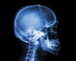 skull at local imaging center at aica orthopedics