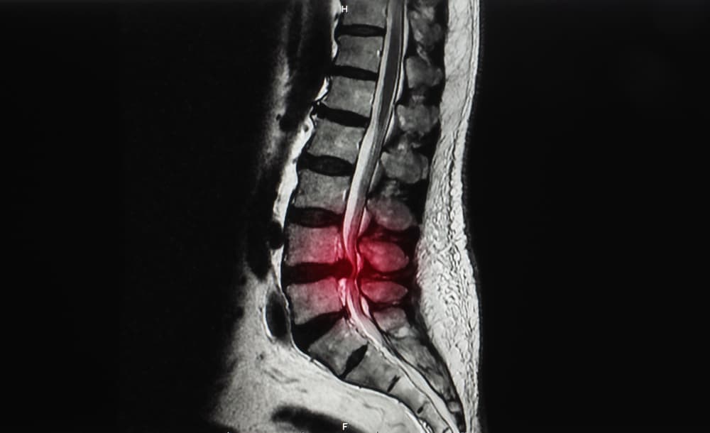 Non-Surgical vs. Surgical Lumbar Decompression