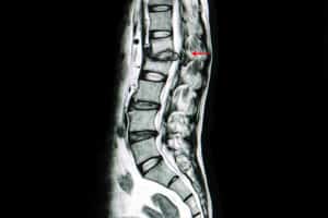 Diagnosing a Bulging Disc
