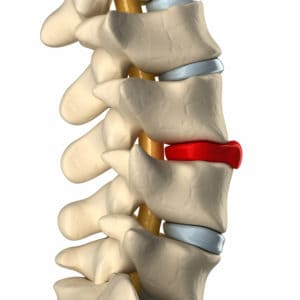 How to Heal a Bulging Disc Naturally